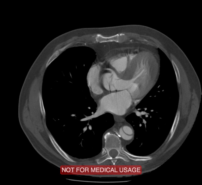 Acute aortic dissection - Stanford type A (Radiopaedia 40661-43285 Axial C+ arterial phase 42).jpg