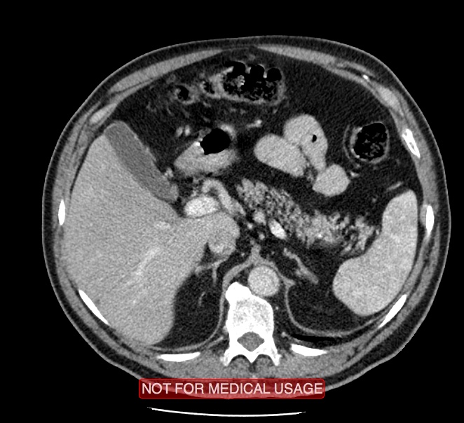Acute aortic dissection - Stanford type A (Radiopaedia 40661-43285 Axial C+ portal venous phase 76).jpg