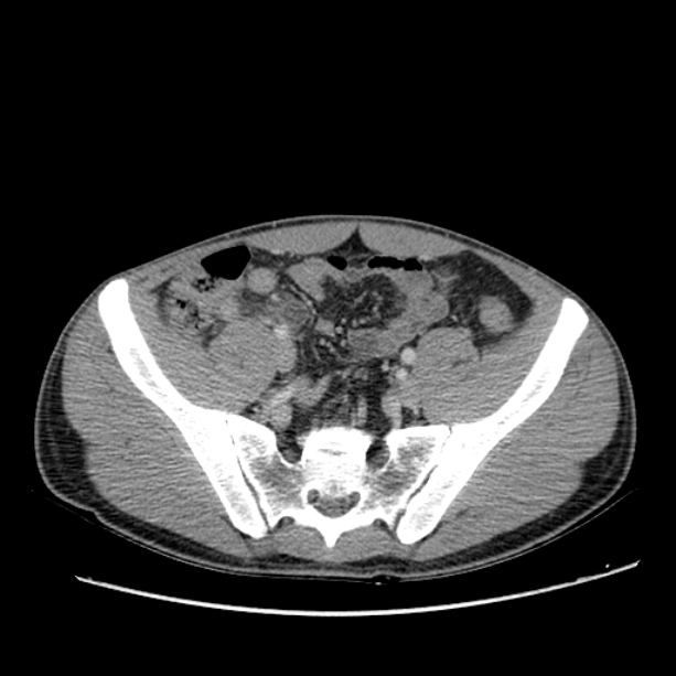 Acute appendicitis (Radiopaedia 27049-27227 Axial C+ portal venous phase 57).jpg