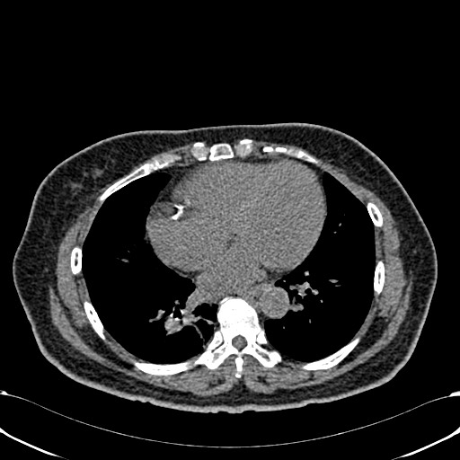 File:Acute appendicitis (Radiopaedia 58627-65818 Axial non-contrast 4).jpg