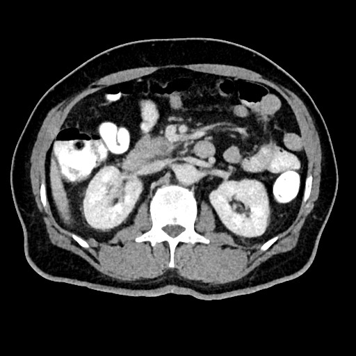Acute appendicitis (Radiopaedia 77016-88960 Axial C+ portal venous phase 58).jpg