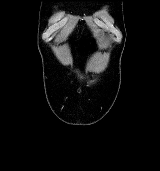 Acute appendicitis (Radiopaedia 77016-88960 Coronal C+ portal venous phase 17).jpg