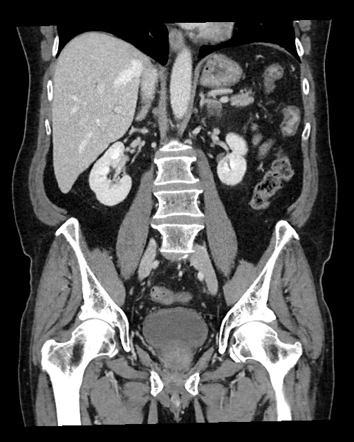 Acute appendicitis - large appendicoliths (Radiopaedia 61805-69820 Coronal C+ portal venous phase 77).jpg