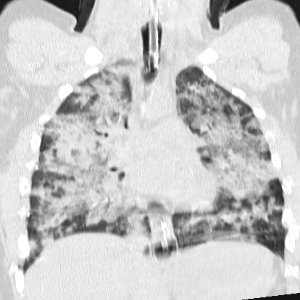 Acute aspiration pneumonitis (Radiopaedia 33605-34703 Coronal lung window 43).jpg