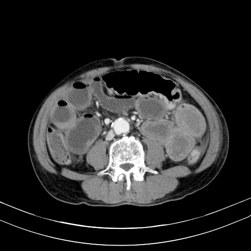 Acute bowel ischemia (Radiopaedia 87695-104114 Axial C+ portal venous phase 49).jpg