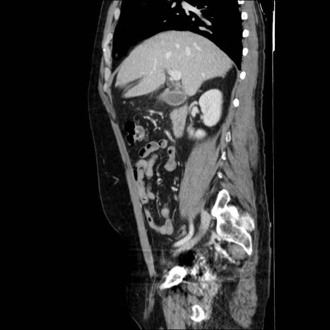 Acute cholecystitis and incidental left sided IVC (Radiopaedia 49352-54459 Sagittal C+ portal venous phase 58).jpg