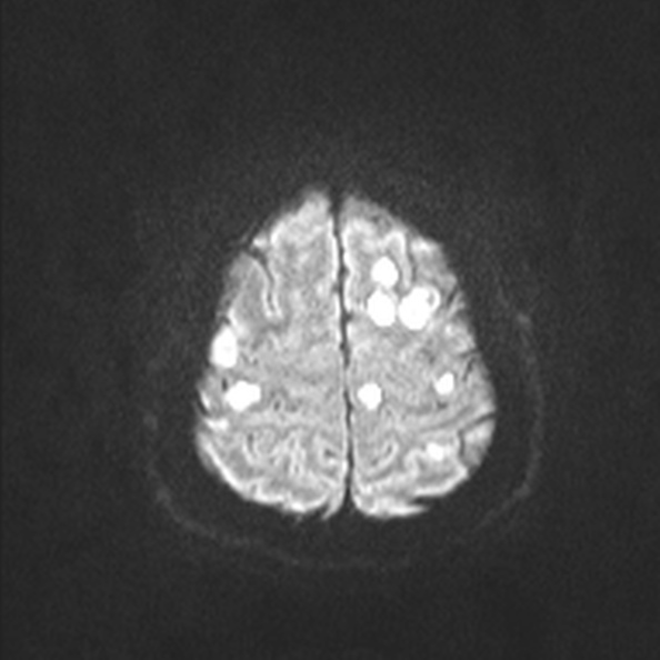 Acute disseminated encephalomyelitis (Radiopaedia 37253-39033 Axial DWI 50).jpg