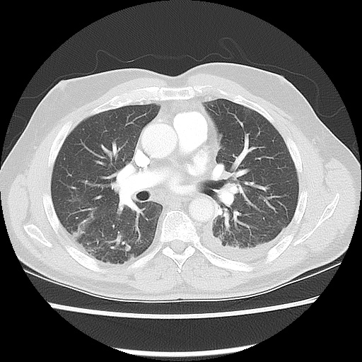 File:Acute epicardial fat necrosis (Radiopaedia 42327-45440 Axial lung window 30).jpg