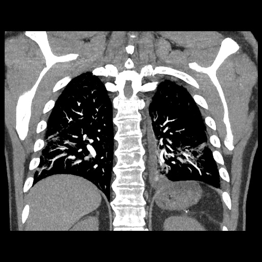 Acute epicardial fat necrosis (Radiopaedia 42327-45440 Coronal C+ CTPA 72).jpg