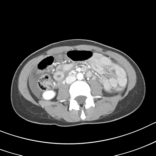Acute gangrenous appendicitis with perforation (Radiopaedia 40152-42662 Axial C+ portal venous phase 36).png