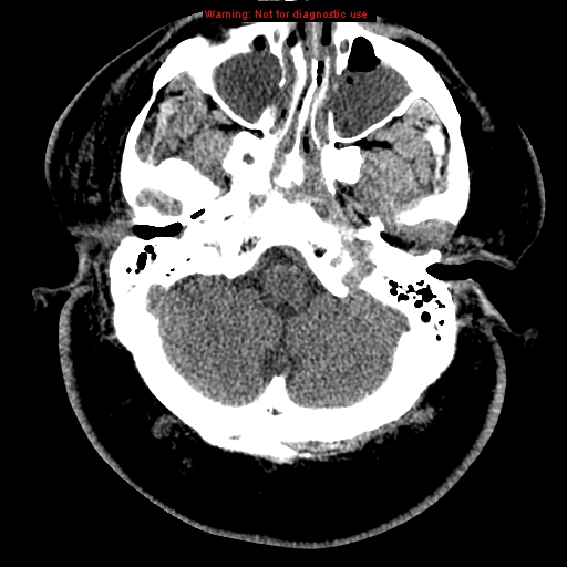 Acute hemorrhagic leukoencephalitis (Radiopaedia 14076-43697 Axial non-contrast 6).jpg