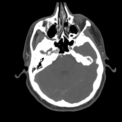 Acute internal carotid artery dissection (Radiopaedia 53541-59630 D 23).jpg