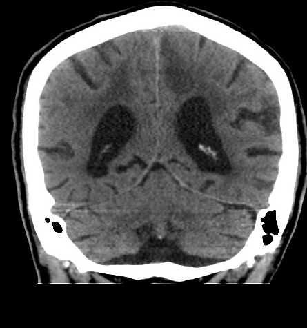 Acute left anterior cerebral artery territory infarction (Radiopaedia 51785-57578 Coronal non-contrast 43).jpg