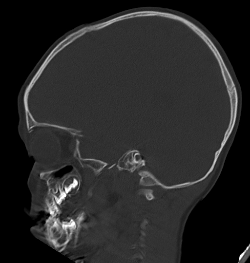 File:Acute mastoiditis (Radiopaedia 82678-96881 Sagittal bone window 22).jpg
