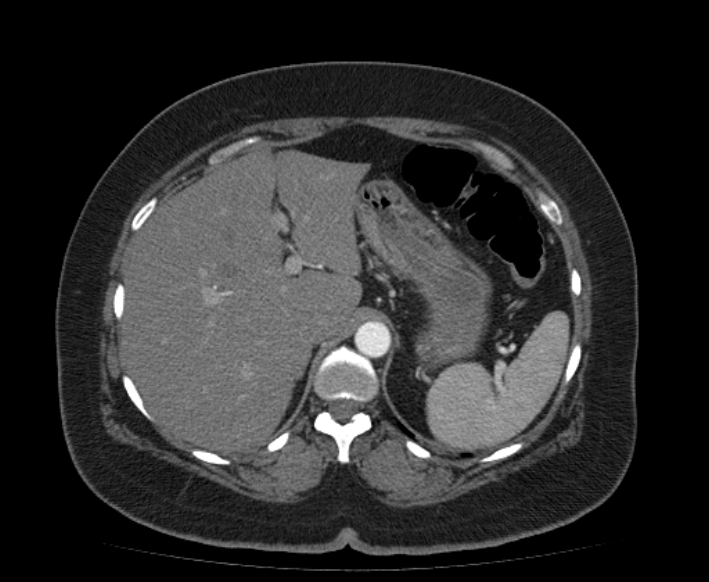 Acute mesenteric ischemia (Radiopaedia 80029-93316 Axial C+ arterial phase 27).jpg
