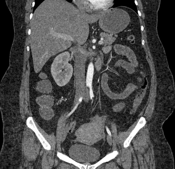 Acute mesenteric ischemia (Radiopaedia 80029-93316 Coronal C+ arterial phase 70).jpg