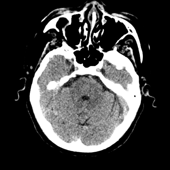 Acute middle cerebral artery territory infarct (Radiopaedia 52380-58283 Axial non-contrast 26).jpg