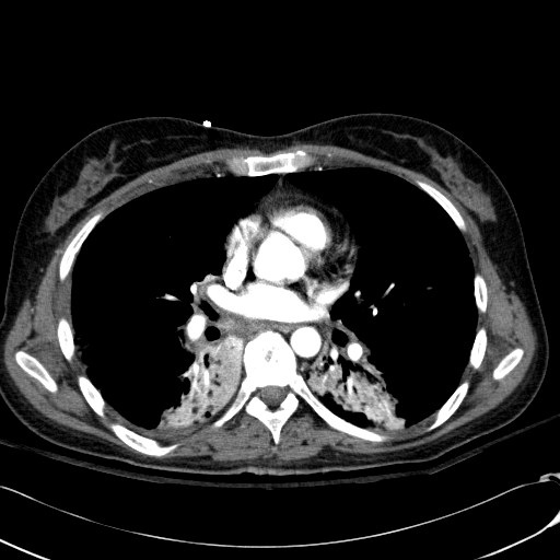 Acute myocardial infarction in CT (Radiopaedia 39947-42415 Axial C+ arterial phase 73).jpg