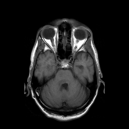 File:Acute necrotizing toxoplasma encephalitis (Radiopaedia 10683-11149 Axial T1 13).jpg