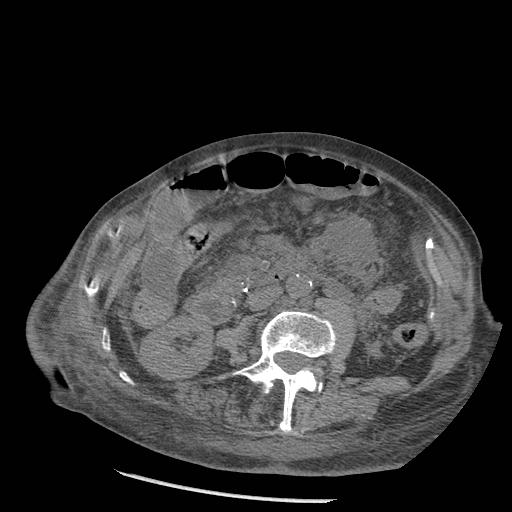 Acute on chronic pancreatitis (Radiopaedia 13233-13244 Axial non-contrast 52).jpg