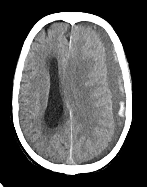 Acute on chronic subdural hematoma (Radiopaedia 74814-85823 Axial non-contrast 52).jpg