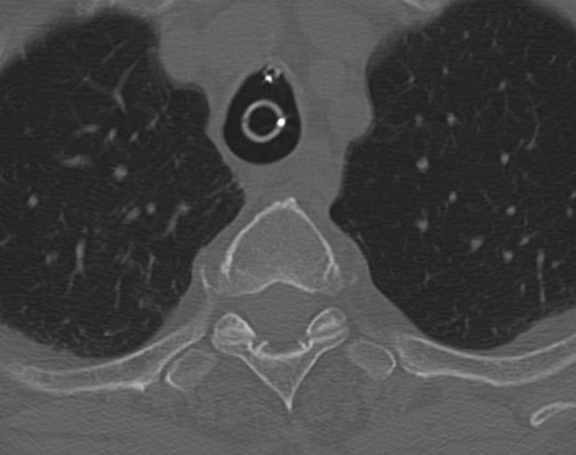 Acute on chronic subdural hematoma and thoracic vertebral injury in a multitrauma patient (Radiopaedia 31698-32619 Axial bone window 69).jpg