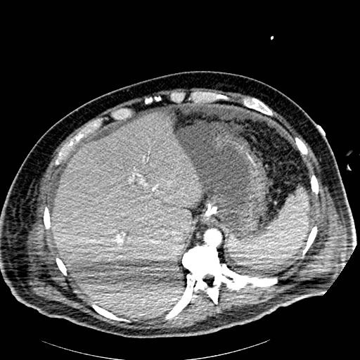 File:Acute pancreatic necrosis (Radiopaedia 13560-18502 Axial C+ portal venous phase 1).jpg