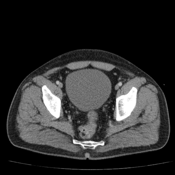 Acute pancreatitis (Radiopaedia 26663-26813 Axial C+ portal venous phase 77).jpg