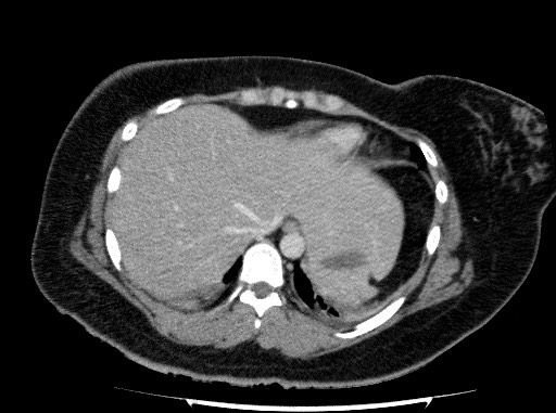 Acute pancreatitis (Radiopaedia 69236-79012 Axial C+ portal venous phase 13).jpg