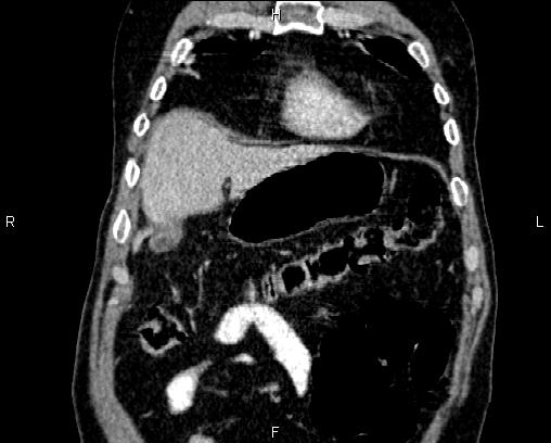 Acute pancreatitis (Radiopaedia 85146-100701 Coronal C+ portal venous phase 11).jpg