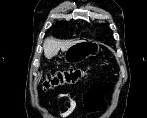 Acute pancreatitis (Radiopaedia 85146-100701 Coronal C+ portal venous phase 7).jpg