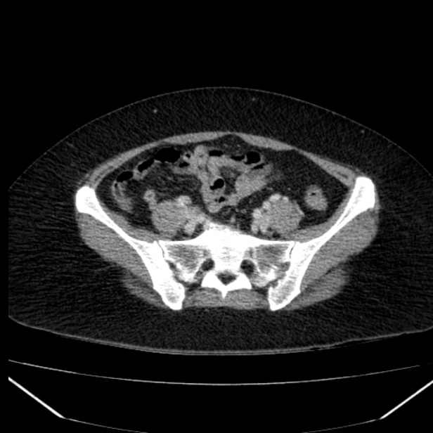 Acute pancreatitis - Balthazar C (Radiopaedia 26569-26714 Axial C+ portal venous phase 73).jpg
