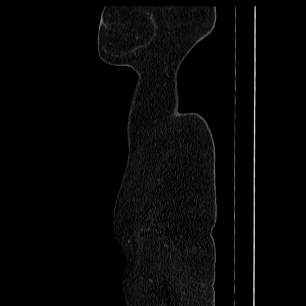 Acute pancreatitis - Balthazar C (Radiopaedia 26569-26714 Sagittal C+ portal venous phase 68).jpg