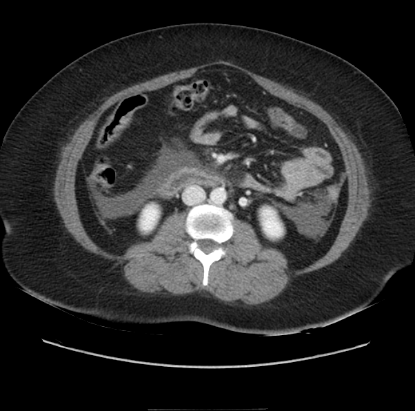 Acute pancreatitis - Balthazar E (Radiopaedia 29016-29377 Axial C+ portal venous phase 35).png