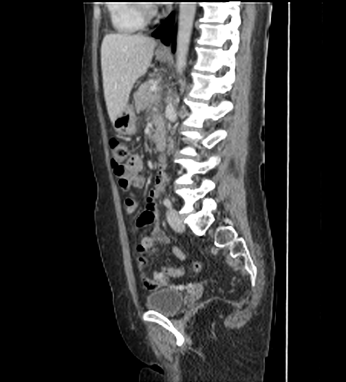 File:Acute pancreatitis - Balthazar E - post ERCP (Radiopaedia 27562-27772 Sagittal C+ portal venous phase 77).png