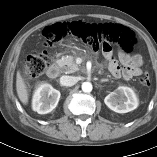 File:Acute pancreatitis and walled-off necrosis (Radiopaedia 29888-30403 Axial C+ portal venous phase 18).jpg