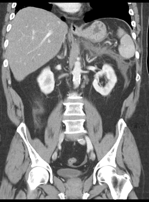 Acute pancreatitis complicated by portal vein thrombus (Radiopaedia 48148-52990 Coronal C+ portal venous phase 38).png