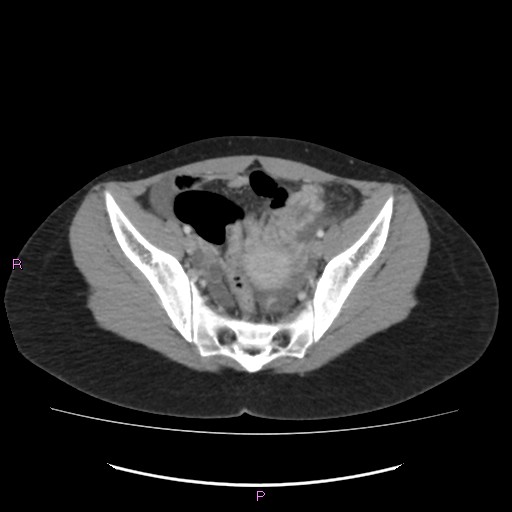 Acute pancreatitis secondary to stone at minor papilla and pancreatic divisum (Radiopaedia 76570-88333 Axial C+ portal venous phase 65).jpg
