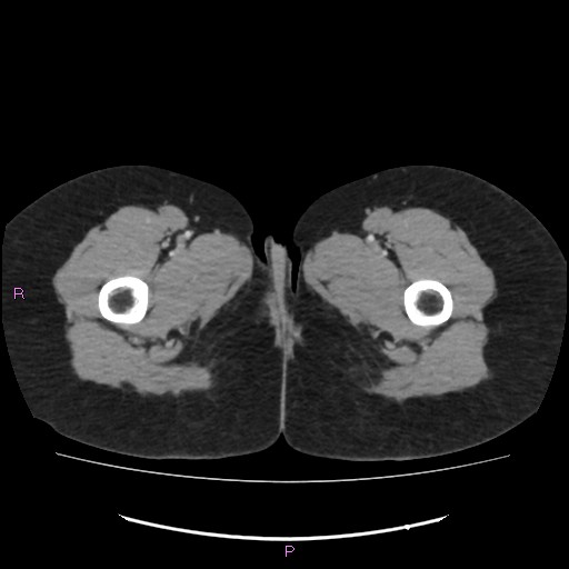 Acute pancreatitis secondary to stone at minor papilla and pancreatic divisum (Radiopaedia 76570-88333 Axial C+ portal venous phase 93).jpg