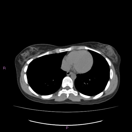 File:Acute pancreatitis secondary to stone at minor papilla and pancreatic divisum (Radiopaedia 76570-88333 Axial non-contrast 2).jpg