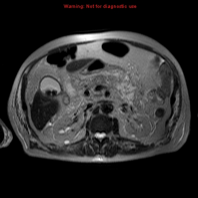 File:Acute pancreatitis with incidental pancreatic lipoma (Radiopaedia 10190-10732 Axial T2 8).jpg