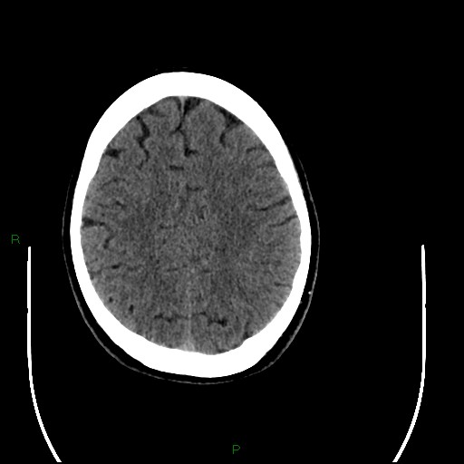 Acute posterior cerebral artery territory infarct (Radiopaedia 79329-92393 Axial non-contrast 81).jpg