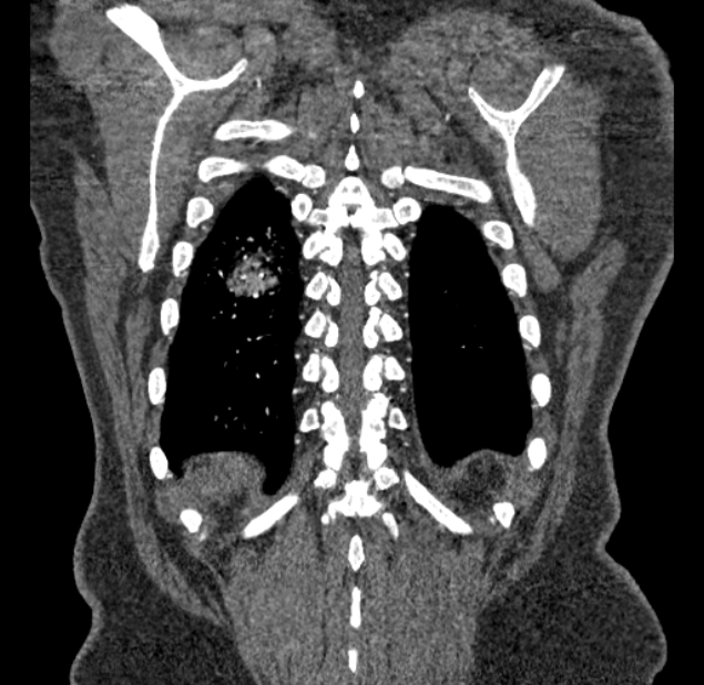 Acute pulmonary embolism with pulmonary infarcts (Radiopaedia 77688-89908 Coronal C+ CTPA 95).jpg