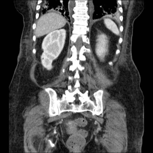 Acute pyelonephritis (Radiopaedia 26584-26729 C+ portal venous phase 56).jpg