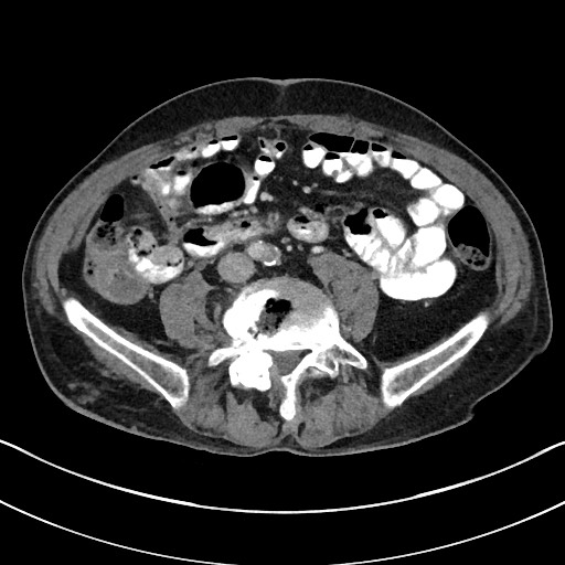 Acute renal infarction - rim capsular enhancement (Radiopaedia 59833-67270 Axial C+ portal venous phase 59).jpg