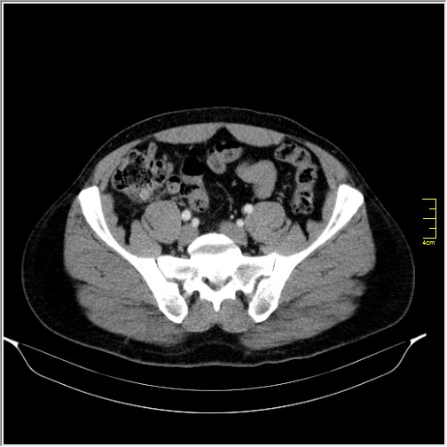 Acute right sided diverticulitis (Radiopaedia 65249-74268 Axial C+ portal venous phase 59).JPG