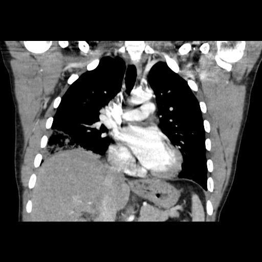 Acute segmental pulmonary emboli and pulmonary infarction (Radiopaedia 62264-70444 Coronal C+ CTPA 24).jpg