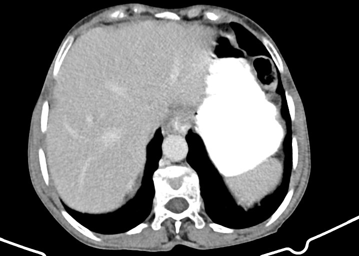 Acute small bowel (ileal) volvulus (Radiopaedia 71740-82139 Axial C+ portal venous phase 49).jpg