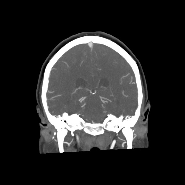 File:Acute subarachnoid hemorrhage and accessory anterior cerebral artery (Radiopaedia 69231-79009 Coronal C+ arterial phase 49).jpg