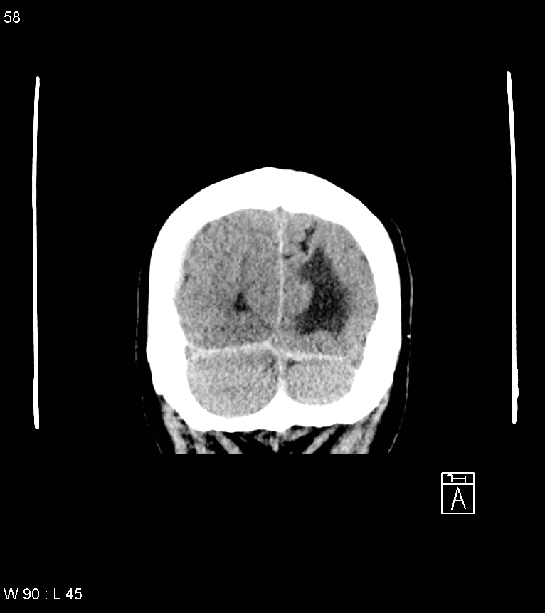 Acute subdural hematoma with myelofibrosis (Radiopaedia 52582-58494 Coronal non-contrast 49).jpg
